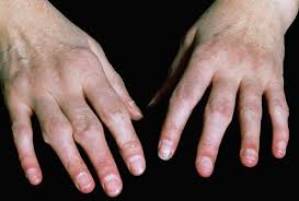 Byram says the most likely culprit is rheumatoid arthritis (which often begins in the hands) gout, a type of arthritis caused by high levels of uric acid in the body, could also be the culprit. Diagnosis And Management Of Rheumatoid Arthritis Prescriberprescriber