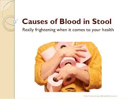 Blood in stool looks different depending on how early it enters the digestive tract—and thus how much digestive action it has been exposed to—and how much there is. Causes Of Blood In Stool