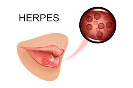 herpes causes symptoms treatments