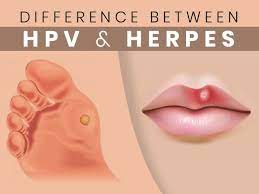hpv and herpes