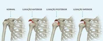 Luxação no Ombro - Tratamento Curitiba - Sharbo Casagrande