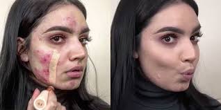 foundation for acne e skin how