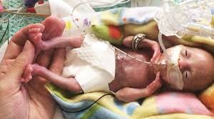 The Most Premature Surviving Baby Was Born At 21 Weeks