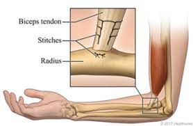 distal biceps tendon repair what to