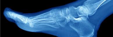 Ankle and foot | radiology key. Five Of The Most Common Foot And Ankle Injuries Rothman Orthopaedic Institute