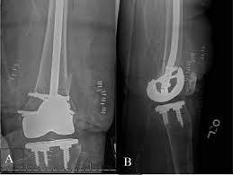 periprosthetic distal femur fractures