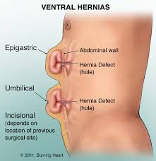 Image result for hernia