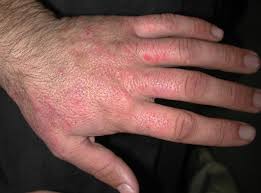 skin irritant contact dermais icd
