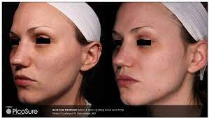 acne scars treatment southton