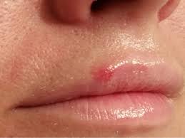 laser cold sore and canker sore