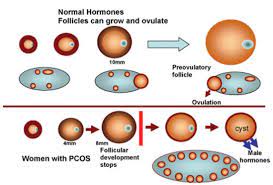 poly cystic ovarian syndrome hair loss