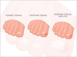 ingrown toenail treatment utation