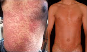 rash ociated with an hiv infection