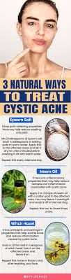 5 best home remes for cystic acne