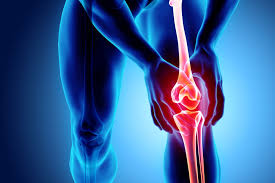 4 warning signs of osteoarthritis - Chris Bailey Orthopaedics