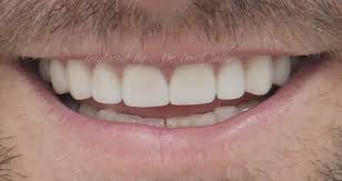 Depends on how big the gaps are. 4 Methods To Close Gaps Between Teeth Trusted Dental Gold Coast