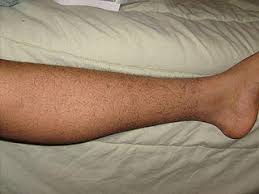 hair loss on legs one or both causes