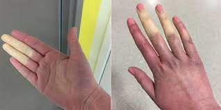 disease causes white or blue fingers