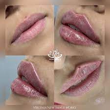 wanted lips lip filler injections new