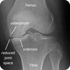 Image result for osteoarthritis xray
