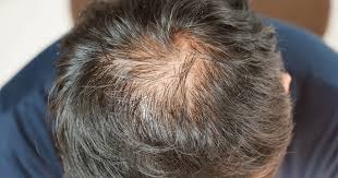 stopping minoxidil does hair fall