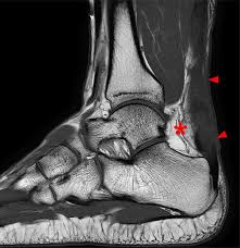 Haglund's syndrome is a group of signs and symptoms consisting of haglund's deformity (which is an exostosis of the posterior calcaneal tuberosity) in combination with retrocalcaneal bursitis. Achilles Tendon Pathology Radsource