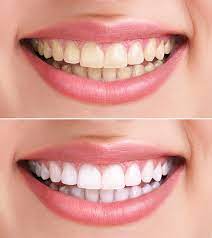 hydrogen peroxide for teeth whitening