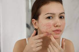 acne scars and pimple marks