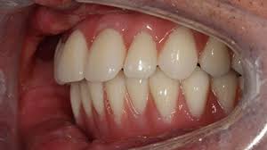 Dentists and orthodontists know how to correct an overbite after years of experience with this treatment in dentistry. How To Fix An Overbite Without Braces College Plaza Dental Associates