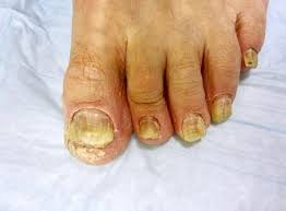 warts timonium foot and ankle center