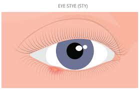 what is a stye what is a chalazion