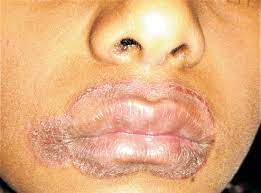 lip smacker s cheilitis