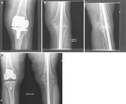 intramedullary arthrodesis of the knee