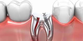 However, this kind of pain is mild and will just disappear by itself over a week or slightly longer. Root Canal Treatment Battersea Endodontist London Chatfield Dental