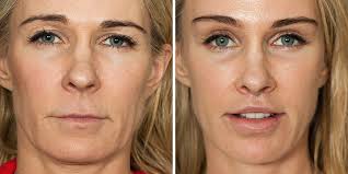 At the plastic surgery clinic we perform approximately 50 to 100 facelifts per year. Facelift Los Angeles Ca Kao Plastic Surgery