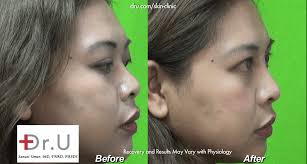 video nose job without plastic surgery