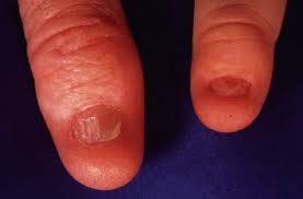 nail patella syndrome springerlink