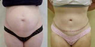 how long is recovery from a tummy tuck