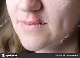 closeup woman lips herpes fever