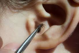 bug in ear signs symptoms removal