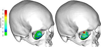 virtual reconstruction of orbital floor