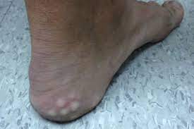 derm dx white lumps on the heel when