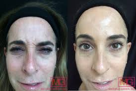 botox for crows feet wrinkle reduction