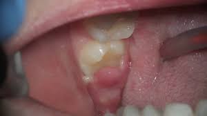 what s this sore gum on wisdom tooth