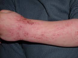 eczema atopic dermais mclean