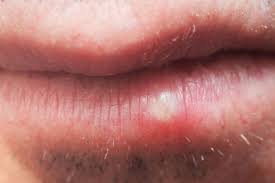 cold sores signs and symptoms