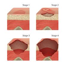 se 3 pressure ulcers explained