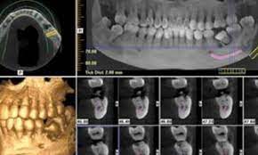 is cone beam 3d cbct xray necessary for