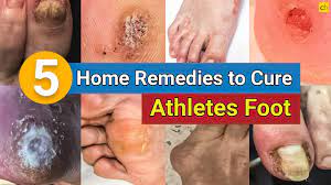5 home remes to cure your athlete s