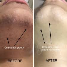 5 leave mixture on face for 8 minutes; Dos And Donts After A Laser Hair Removal Session 2021
